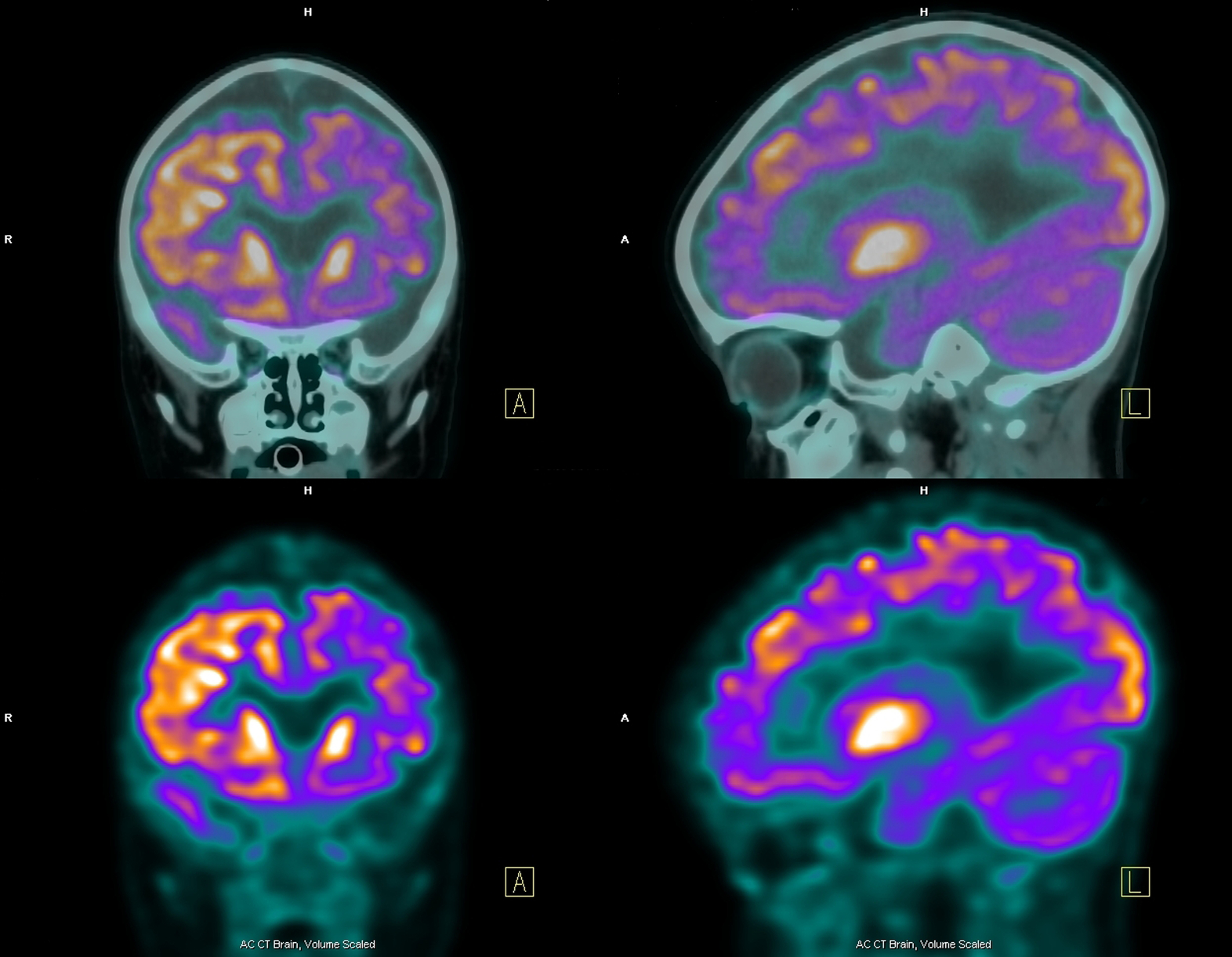 Une recherche détaille une nouvelle méthode de diagnostic qui serait, selon les auteurs de l'étude, capable de détecter 91% des cas de maladies d'Alzheimer.