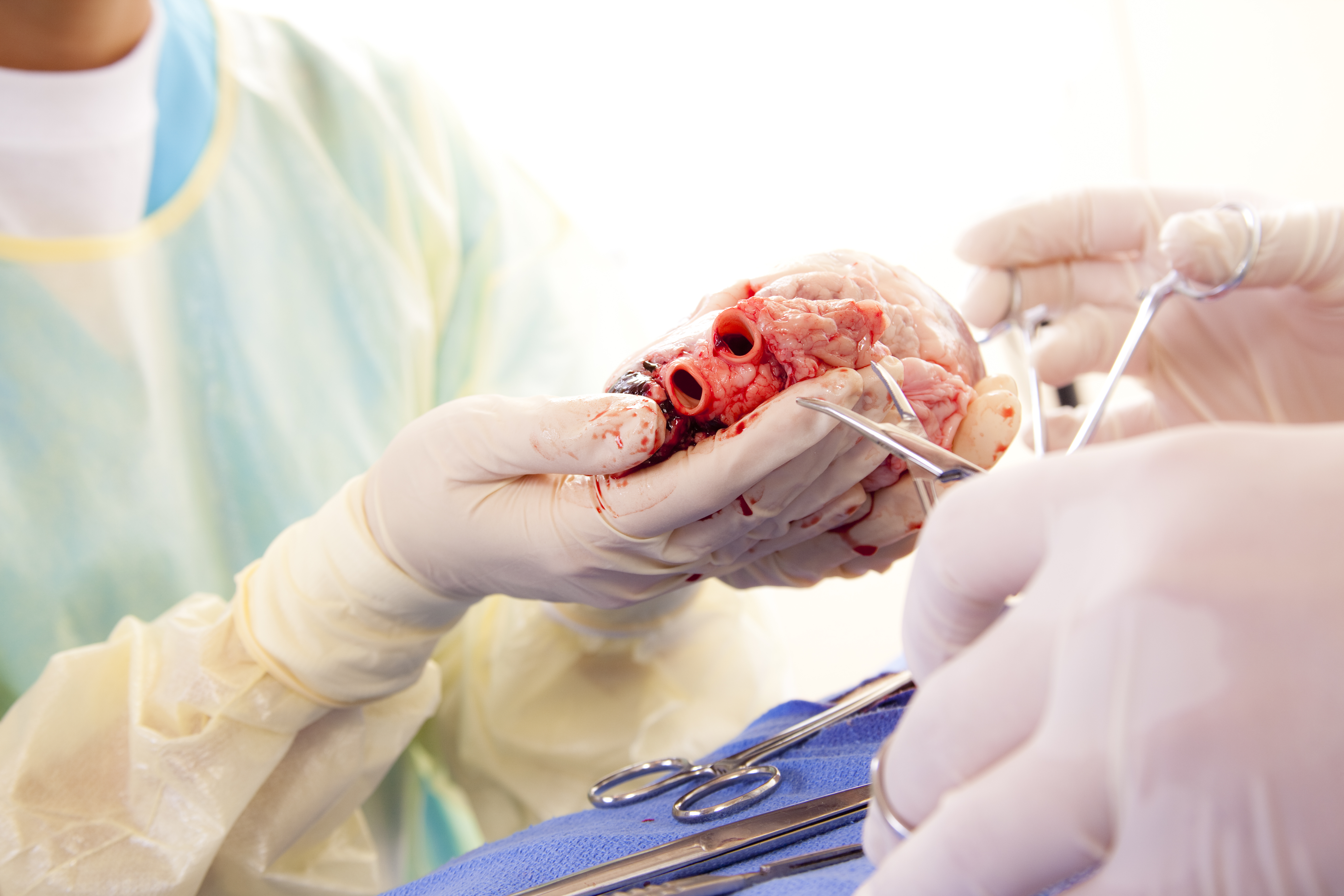 greffe cardiaque