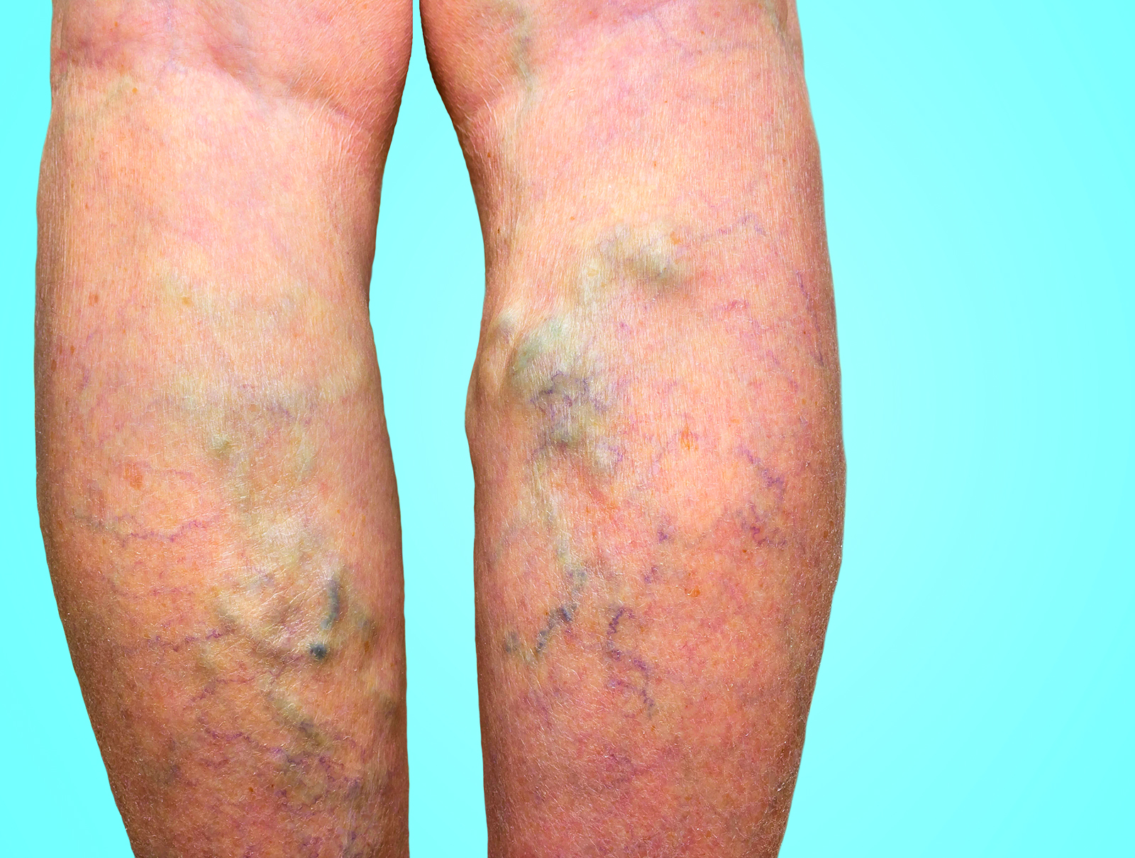 varices